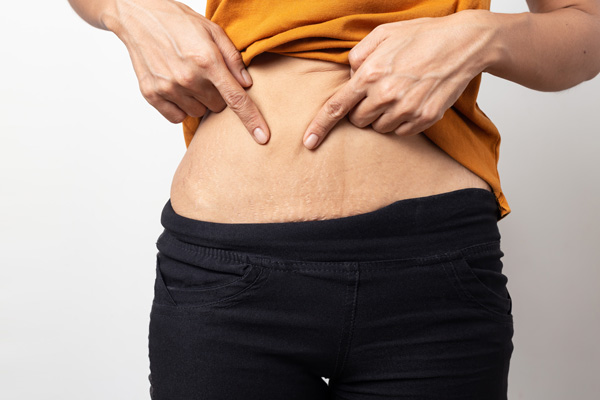 Woman Pointing at Stretch Marks on Stomach