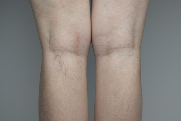 Womans Legs Showing Spider Veins