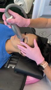 Close-up of a Scarlet SRF radiofrequency microneedling treatment on a client's face at Rejuvenate Renew in Scottsdale, Arizona
